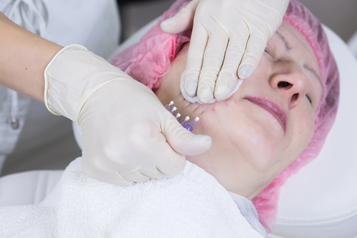 Obrazek przedstawia usługę Nici PDO