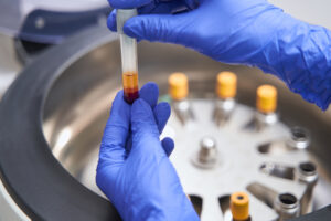 Obrazek przedstawia usługę Osocze Bogatopłytkowe i fibryna (PRP & PRF)